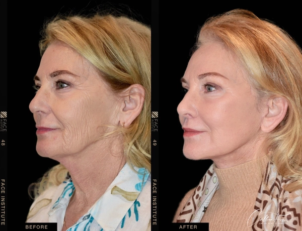 before and after deep plane facelift example