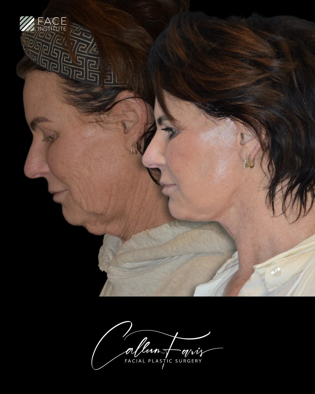 Before and after deep plane facelift