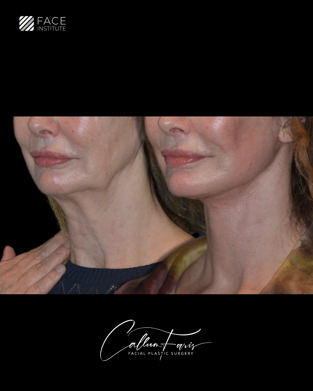 Before and after deep plane facelift