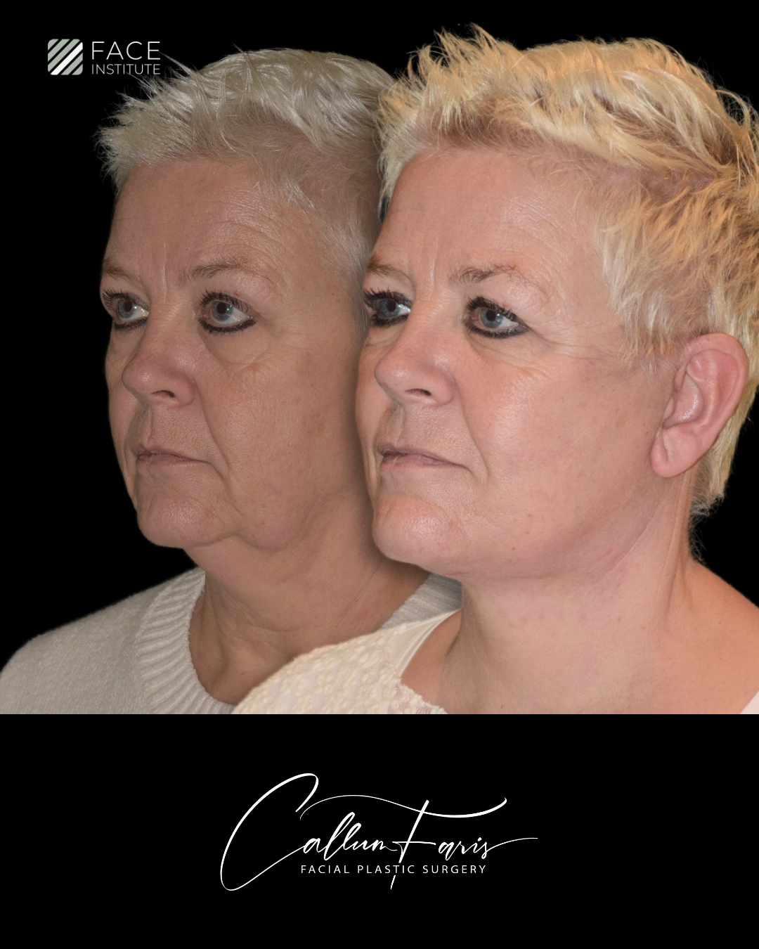 Before and after deep plane facelift