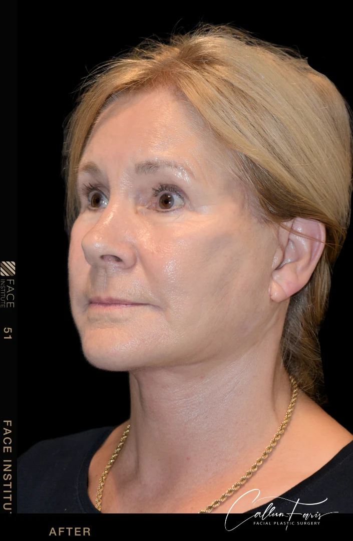 Deep plane facelift example 2 before