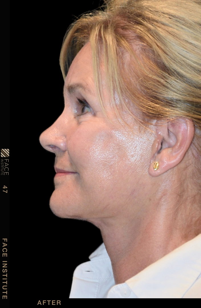 Deep plane facelift example 4 before