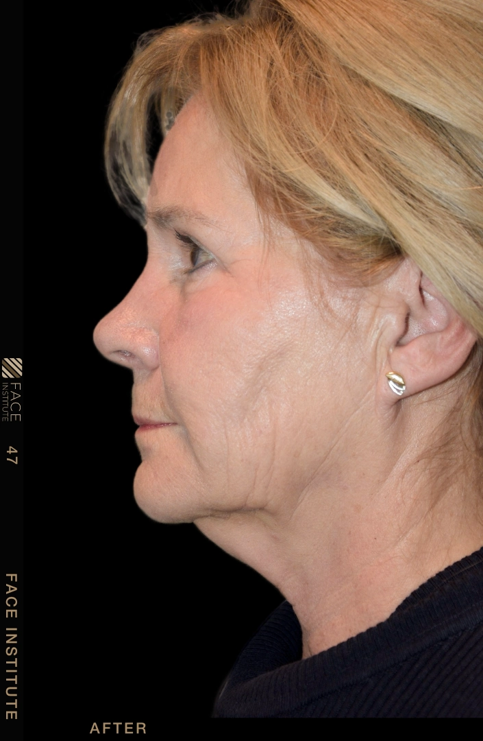 Deep plane facelift example 4 after