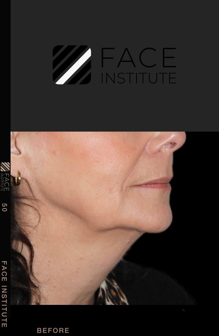 Deep plane facelift example 4 before