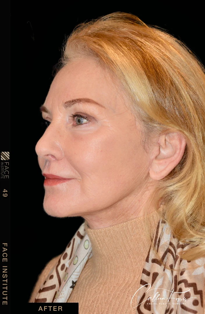 Deep plane facelift example 3 before