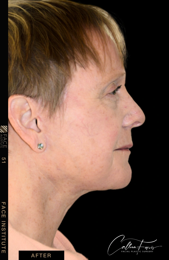 Deep plane facelift example 4 after