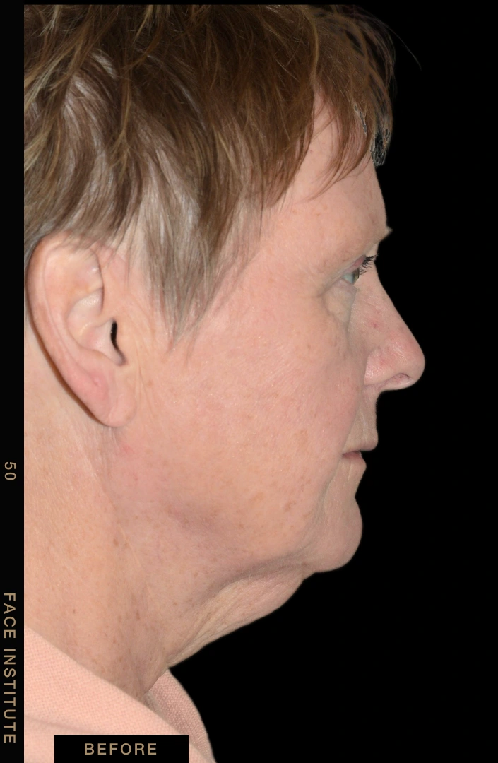 Deep plane facelift example 4 before