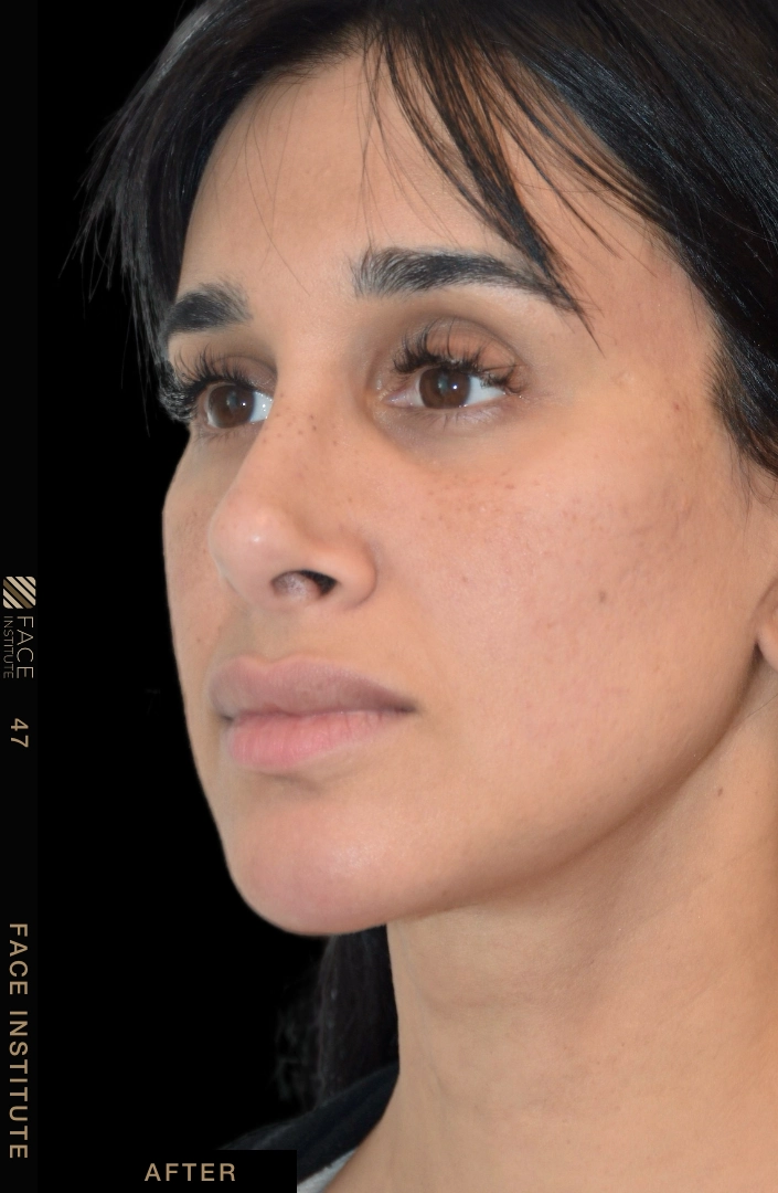 Deep plane facelift example 4 before