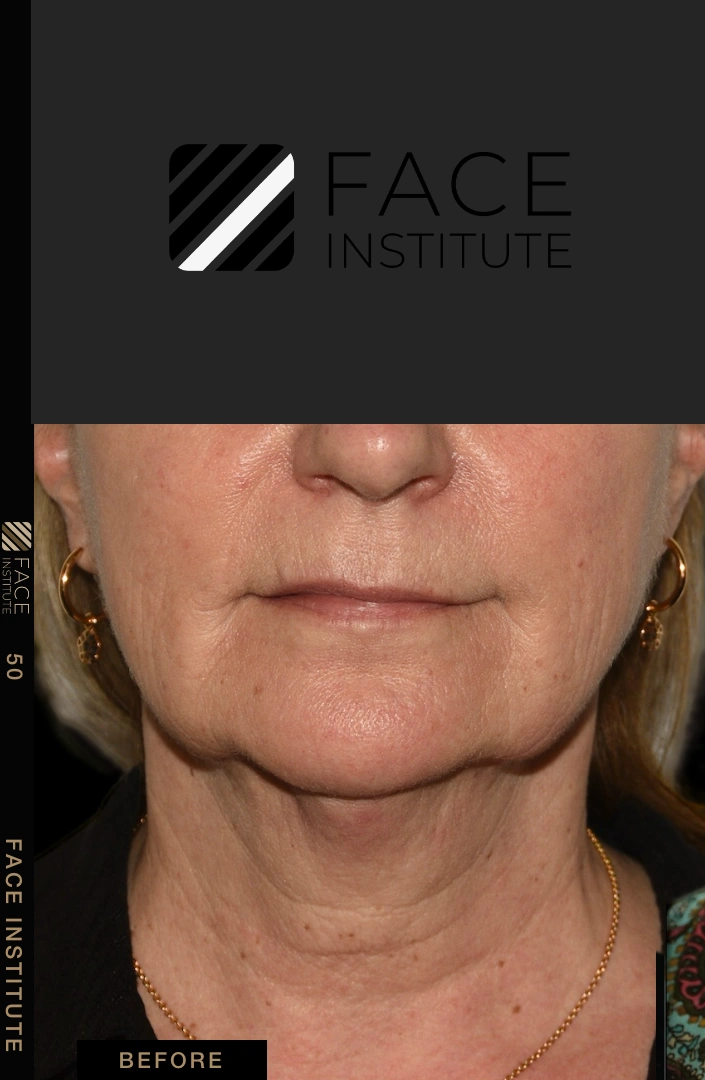 Deep plane facelift example 4 before