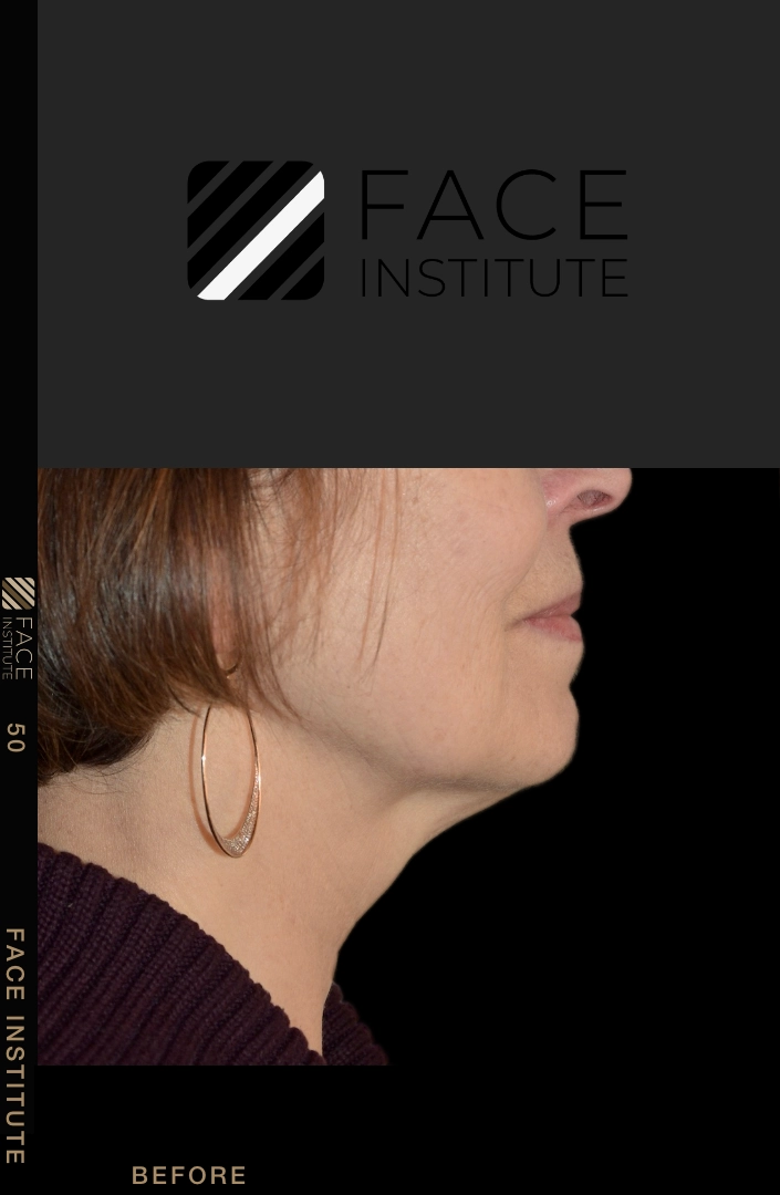 Deep plane facelift example 4 before