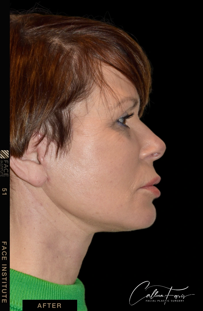 Deep plane facelift example 4 after