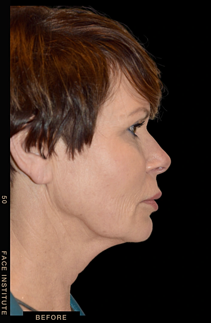 Deep plane facelift example 4 before